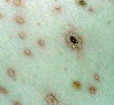 They are so small it's difficult how to prevent chiggers. Chiggers