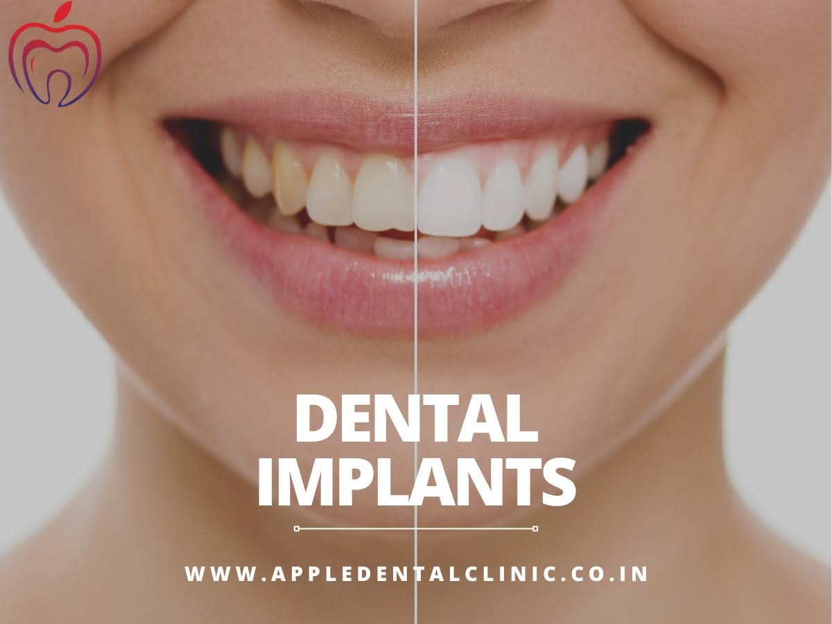 Dental Implants product image