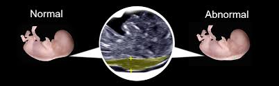 Most units offer a nuchal translucency nt ultrasound scan, so that can be carried out and 14 weeks. 12 Week Nt Scan Fetal Nuchal Translucency Test Dating Induced Info