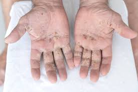 All structured data from the file and property namespaces is available under the creative commons cc0 license; Hautkrankheit Atiopischer Winterfuss Fussekzem Hautekzem Dermatitis Plantaris Sicca Ekzemkrankheiten Atopisches Ekzem Hautausschlag Stock Foto Adobe Stock