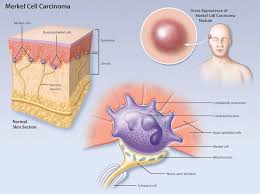 Image result for Merkel Cell Carcinoma