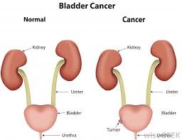 Even if you're vigilant about getting routine gyn care, bladder cancer may not really be on your radar. What Is A Bladder Mass With Pictures