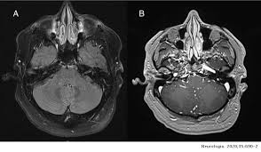 Clippers syndrome (chronic lymphocytic inflammation with pontine perivascular enhancement responsive to steroids) is a recently described rare disease affecting the central nervous system. Clippers Syndrome A Case Report Neurologia English Edition
