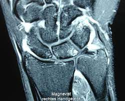 Glättung des triangulären fibrocartilaginären complexes. Ellenseitiger Handgelenksschmerz