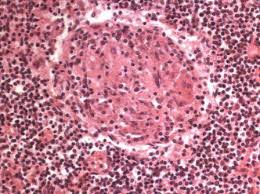 Granuloma Was Ist Das Granulom Behandlung Ursachen