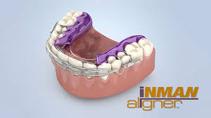 Lynn price has looked after the family's teeth for the last 22 years for our twice yearly check ups and i have to say with her dental hygiene guidance on how to look after our teeth we have never had any fillings or any work at. Inman Aligner Peach Dental