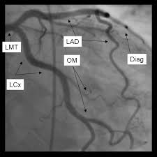 Coronary Angiography Standard Views Wikidoc