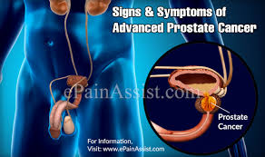 Stomach cancer begins when abnormal cells begin to grow in the cells of tissues lining or surrounding your stomach. Signs Symptoms Of Advanced Prostate Cancer