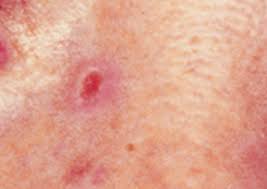Basalzellkarzinom The Skin Cancer Foundation