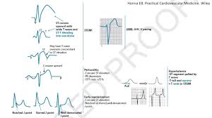 Image result for ST Elevation