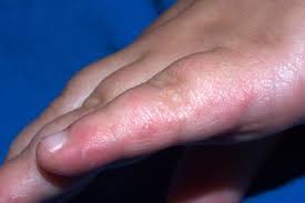 I had a red itchy rash only on the tops of both feet for 6 months. Rashes In Babies And Children Nhs