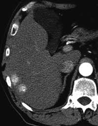 The incidence of clinically evident … Secondary Liver Tumors Intechopen