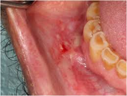 Image result for Aphthasol