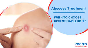 Image result for Skin Abscess