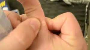 Skip the home remedy and use america's most trusted wart care brand. Best Wart Removal Using Compound W Freeze Off Wart Remover Diy Wart Removal Products Youtube