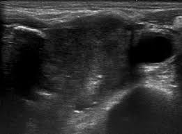 Ultrasound energy is rapidly to 2 ml of 3% hydrogen peroxide solution placed on a watch glass (against a black background) one drop of punctate is added. Figure 4 Application Of Ultrasound Guided Core Needle Biopsy In The Diagnosis Of T3 Or T4 Stage Laryngeal And Hypopharyngeal Cancer Anticancer Research