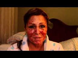 Skin Cancer... My Vlog EFUDEX JOURNAL... vid#11.
