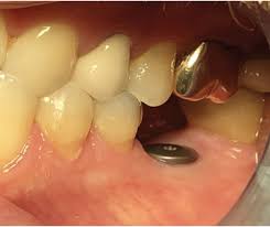 Federal grants for dental implants scam. Dental Implant Surgery With Robotic Guidance Oral Health Group