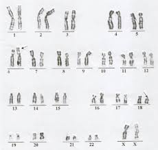 karyotype for patient 2 download scientific diagram