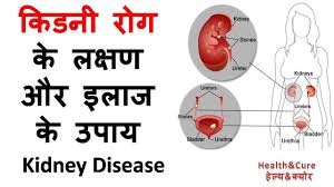 Kidney Rog Ke Lakshan Aur Ilaj Ke Upay Kidney Disease In Hindi Treatment For Kidney Disease Kidney Disease Chronic Kidney Disease