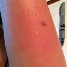 To see how everything turned out in this case, take a look at. How To Treat A Brown Recluse Spider Bite Bronze Media