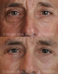 Des prix pas cher proposés par carthage nous proposons des prix chirurgie esthétique tunisie tout compris incluant à la fois votre opération. Photos Avant Apres De Chirurgie Esthetique Des Paupieres