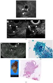 Not all tests listed below will be a scanner then detects this substance to produce images of the inside of the body. Diagnostics Free Full Text Endoscopic Ultrasound For Early Diagnosis Of Pancreatic Cancer