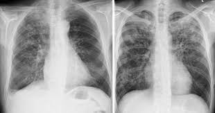 Die Vielen Gesichter Der Pneumonie Healthcare In Europe Com