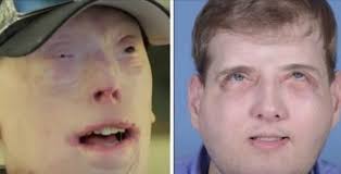 El bombero que apagó un incendio y destruyó su cara: la nueva vida del  hombre sin rostro