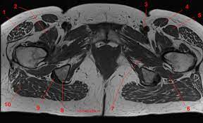 Mri patterns of neuromuscular disease involvement thigh & other muscles 2. Mri Of The Hip Detailed Anatomy W Radiology