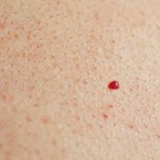Titik merah yang besar pada kaki mungkin berlaku disebabkan oleh perkembangan mycosis. Begini Cara Mengatasi Bintik Merah Di Kulit Pertanda Tumor Jinak Citizen6 Liputan6 Com