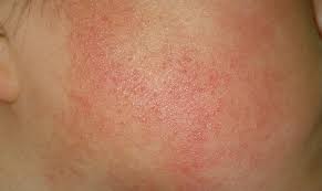 uzm dr hakan buzoglu dermatoloji uzmani