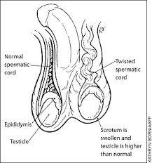 My nuts both swelled up to the size of a cell phone. Testicular Torsion What You Should Know American Family Physician