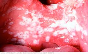 Image result for Oral thrush roof of mouth