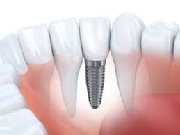 6 coverage options for dental implants. Best Dental Implants In San Diego Affordable Dental Implants San Diego