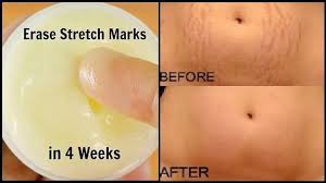 Stretch Marks Bio Oil Gel Before And After This Cream Will Erase All Stretch Marks From Your Skin Like Rubber Stretch Marks Skin Care Aloe Vera Gel