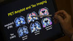  SF scientists erase Alzheimer-causing gene in human brain