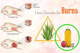 16 Soothing Remedies To Heal A Burn Fast At Home Home Remedies For Burns Burn Remedy How To Heal Burns