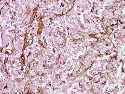 Diseases caused by members of mucorales (genera are rhizopus, rhizomucor, mucor, absidia, aphphysomyces, cunninghamella, saksenaea, etc.) should be named mucormycosis and are. Webpathology Com A Collection Of Surgical Pathology Images