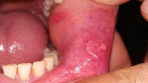 Image result for gums cancer symptoms