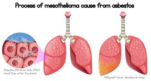 Symptoms of mesothelioma and asbestos exposure. Ukata On Twitter Asbestos Fact Exposure To Asbestos Fibres Can Cause Asbestos Related Diseases Such As Mesothelioma Asbestosis And Lung Cancer For More Information About Asbestos Related Diseases Please Visit Our Website Https T Co Svfpsrc9uv