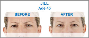 Anteneh roba, md board certified physician Xeomin Injections Botox Sykesville Maryland Vitality Aesthetics