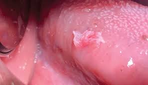 Image result for papillomavirus tongue)