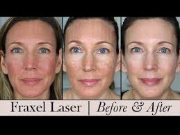 Fraxel results after 1 treatment. Fraxel Face Laser Before After 3 Month Update Youtube