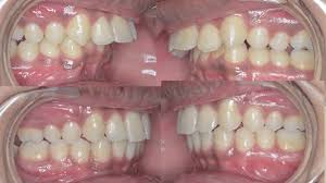 Braces move teeth faster than the other methods to fix an overbite and correct all the orthodontic issues. How To Fix Overbite Without Braces Vtwctr
