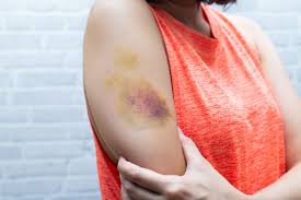 · kleinste blutungen in den beinen aufgrund von venenschwäche · stoffwechselstörungen z. Purpura Was Sind Die Hauteinblutungen
