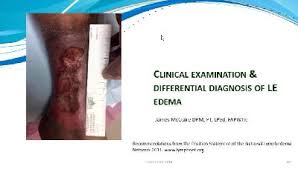 Image result for Edema Exam