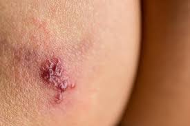 Medications can help reduce your symptoms, speed up the healing of an outbreak and make. Is It Shingles Symptoms Vs Other Conditions And Causes