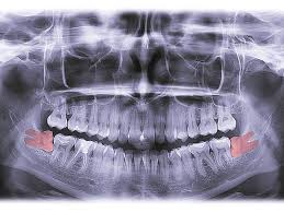 Image result for Alveolitis sicca)