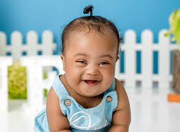 Introduction and photo of trisomy 18 baby